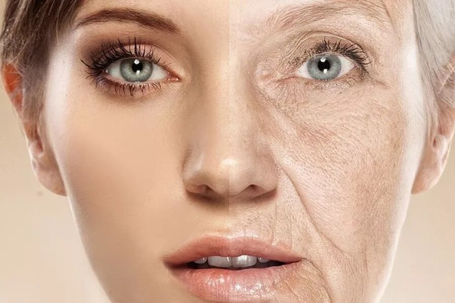 Az arcbőr a frakcionált ablatív lézerrel való érintkezés után és előtt
